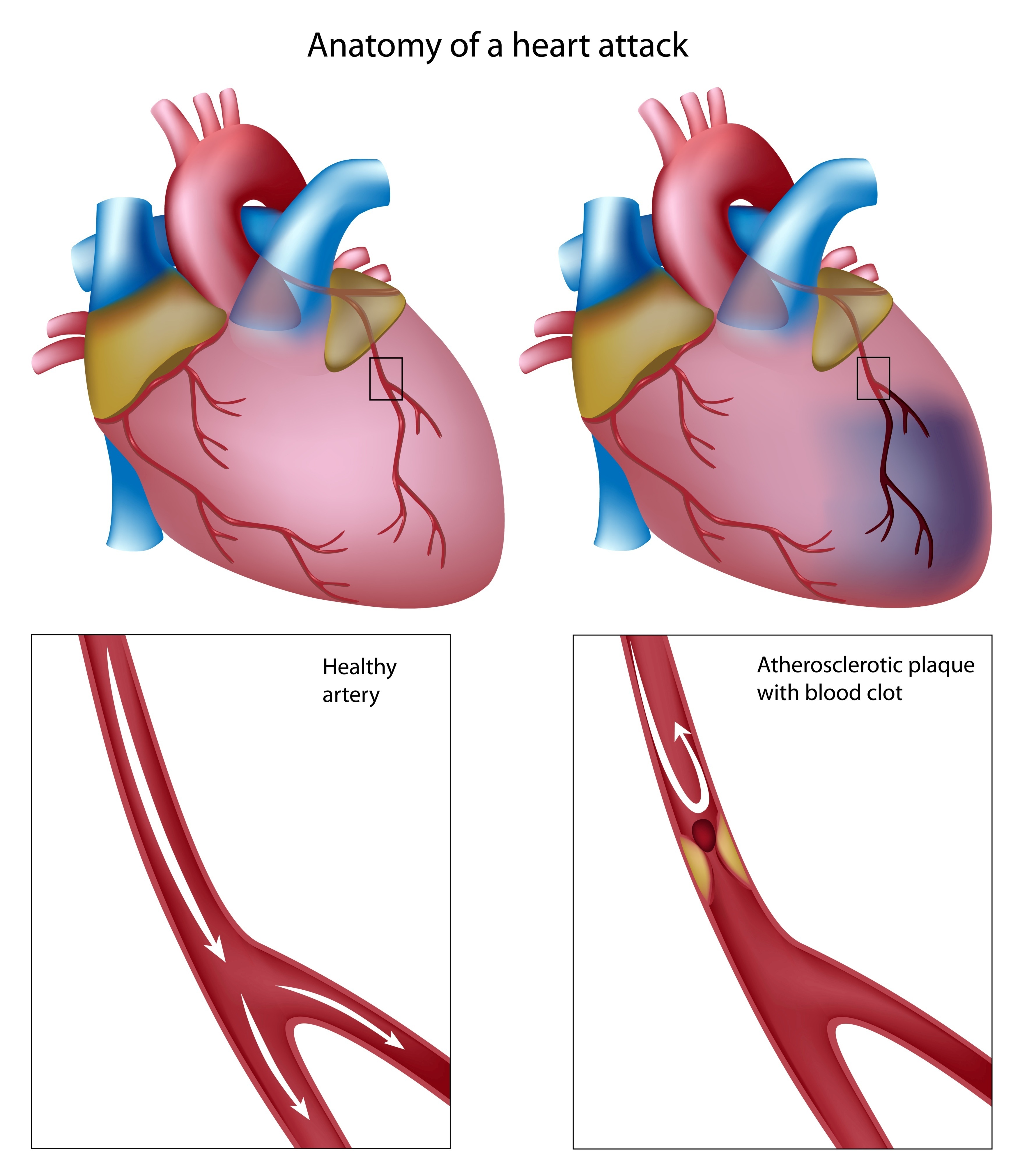 Heart Disease Clipart | Free download on ClipArtMag