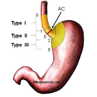 320x320 drawing showing siewert classification ac = anatomical cardia
