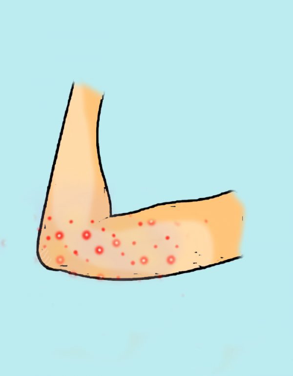 600x771 things that cause acne on different parts of the body and how