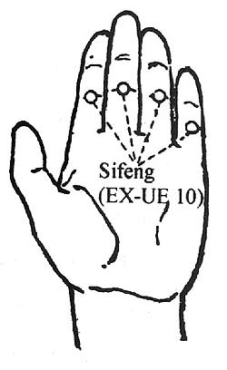250x408 bleeding peripheral points an acupuncture technique