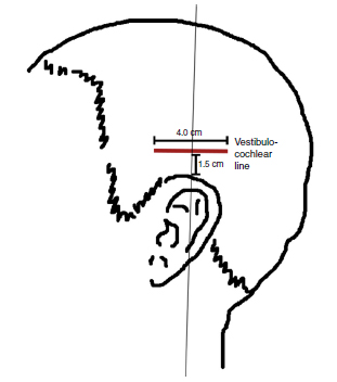 311x352 effectiveness of acupuncture therapy as treatment for tinnitus