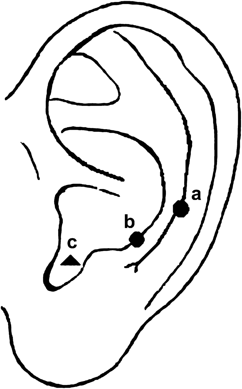 850x1364 insertion points of the acupuncture needle in the ear