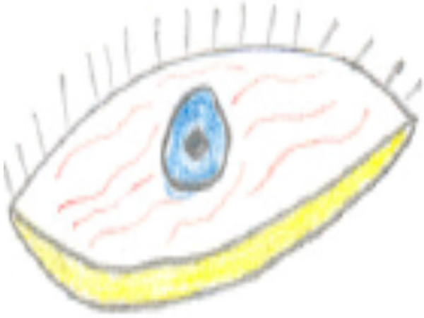 600x450 Drawing Of Diseased Eyes