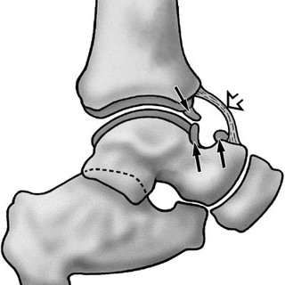 320x320 drawing of the ankle shows the most common sites for anterior