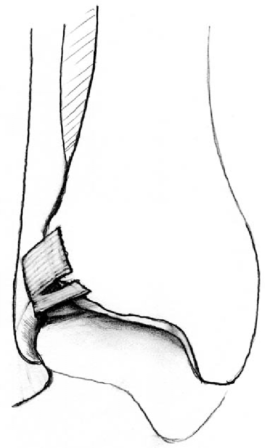 540x913 line drawing of an anterior inferior tibiotalar ligament tear