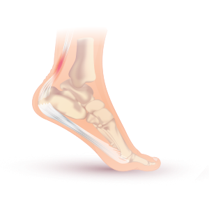300x299 achilles tendinitis