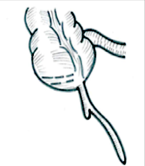 479x549 Diagram Showing The Unusual Bifid Appendix Download Scientific