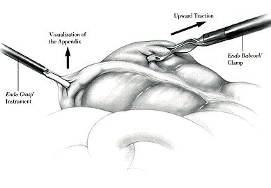 389x270 Laparoscopic Appendectomy