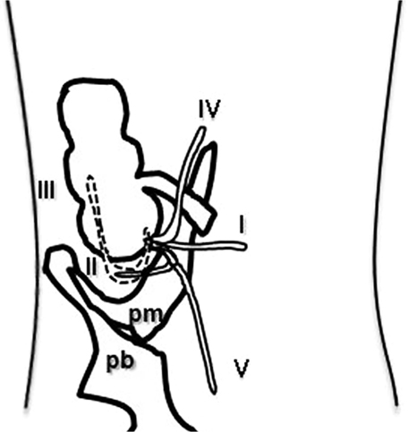 456x483 Multi Detector Ct Findings Of The Normal Appendix In Children