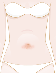 240x310 Navel Fungal Infections How To Diagnose And Treat Fungal Infections