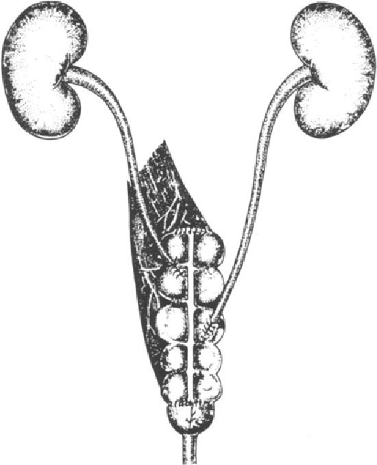 550x678 Continent Sigmoid Bladder After Cystectomy Years' Experience
