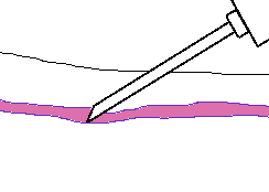 244x174 Phlebotomy Tutorial For Medical Education