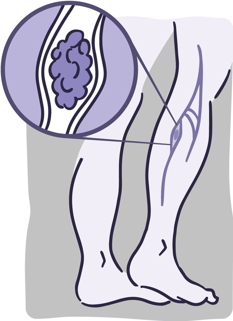 800x1100 How To Spot And Prevent Deep Vein Thrombosis Nih News In Health