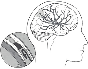 288x228 Uh Stroke Center University Hospital, Newark, Nj
