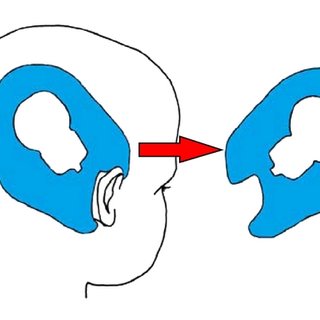 320x320 drawing of a paper blueprint of the position of the implant