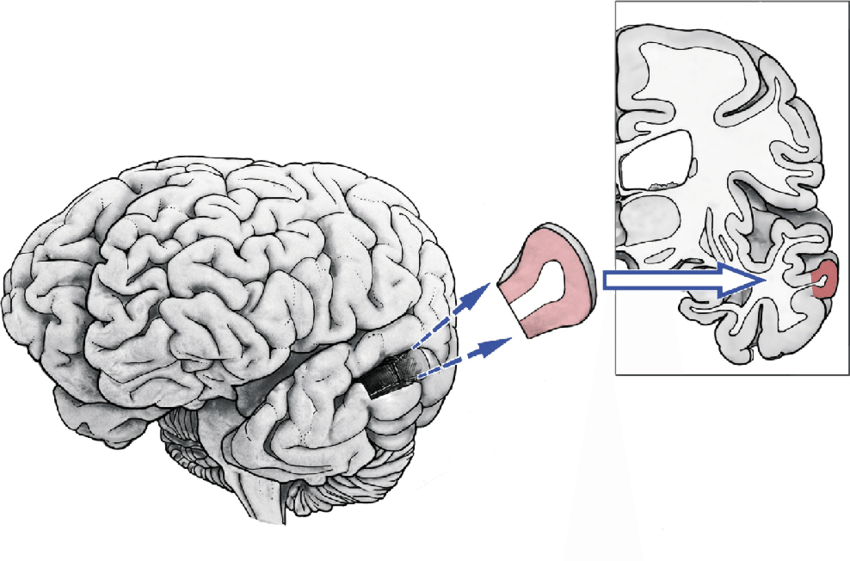 850x561 Schematic Drawing Of The Dissected Human Brain Tissue Probes
