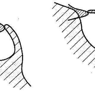 320x320 Drawing Showing A Sella Turcica Bridge, Type A Download