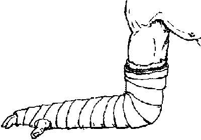 400x278 Homemade Casts For Keeping Broken Bones In Place