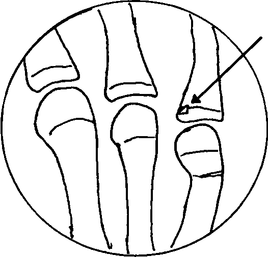 526x506 Figure From Broken Hand Or Broken Nose A Case Report