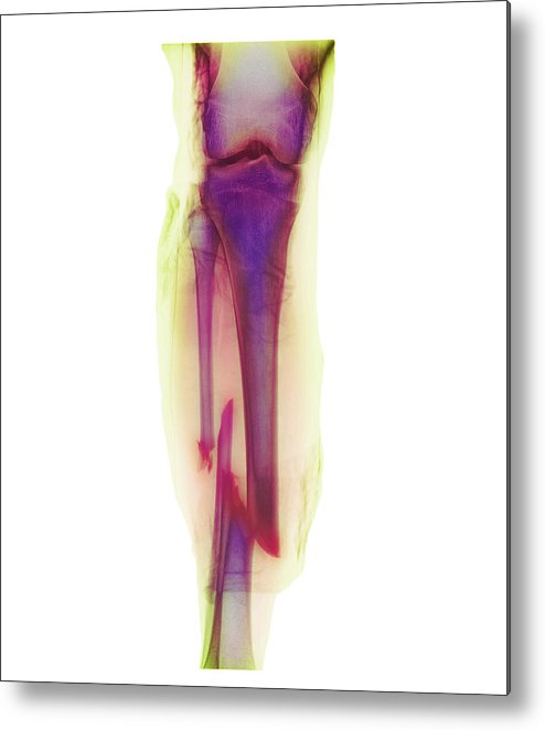 494x662 Broken Leg Metal Print