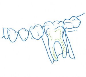 300x267 Root Canal Therapy Belmont Dental Practice
