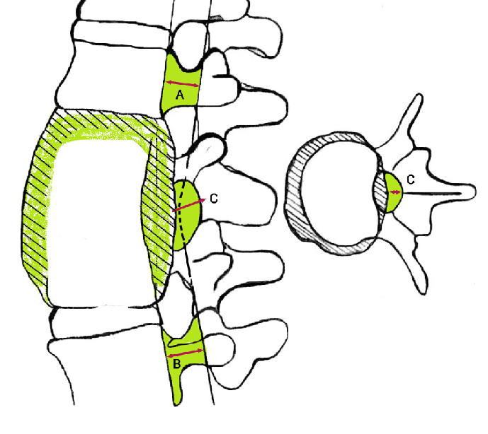 689x614 schematic drawings show the percentage of spinal canal compromise