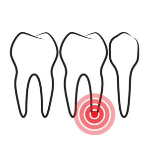 300x300 What You Need To Know About Root Canal Treatment Dental Depot