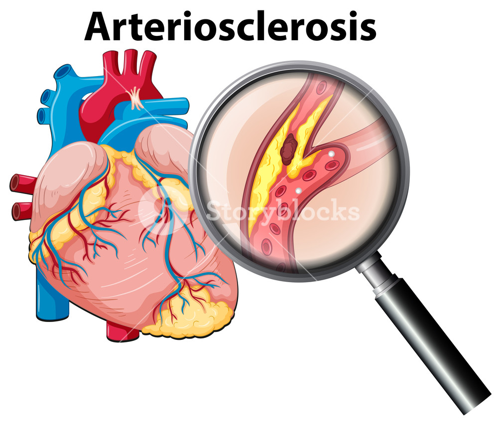 1000x856 Human Heart And Arteriosclerosis Royalty Free Stock Image