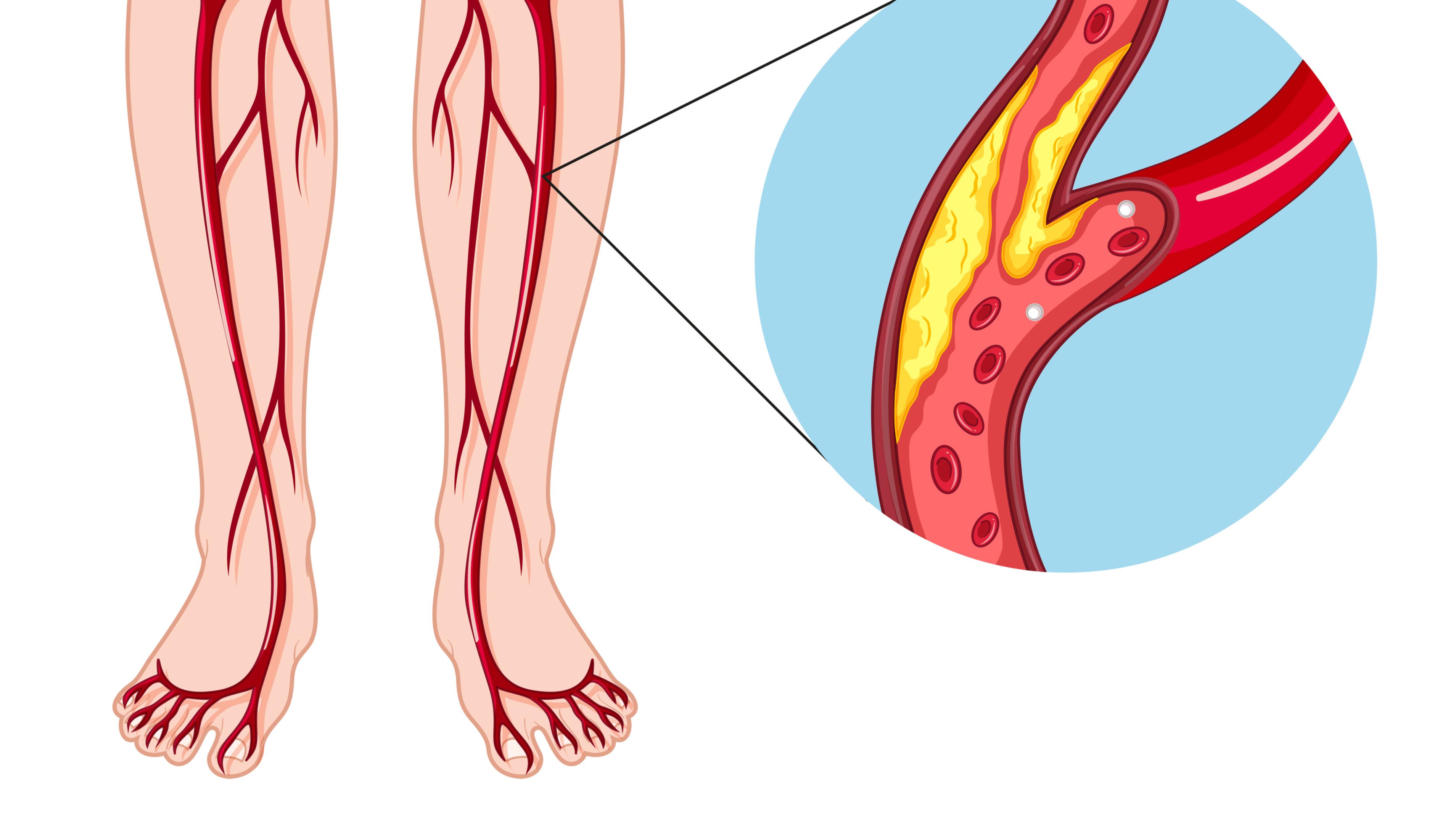Лечение заболеваний артерий. Облитерирующий атеросклероз вен нижних конечностей. Облитерирующий атеросклероз сосудов конечностей. Облитерирующий атеросклероз сосудов ног. Атеросклероз артерий нижних конечностей.