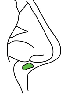 200x313 Plumping Graft Dr Anil R Shah