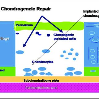 320x320 schematic drawing of a cartilage defect that has been treated