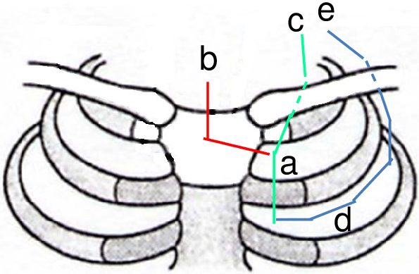 595x389 the second rib cartilage was cut