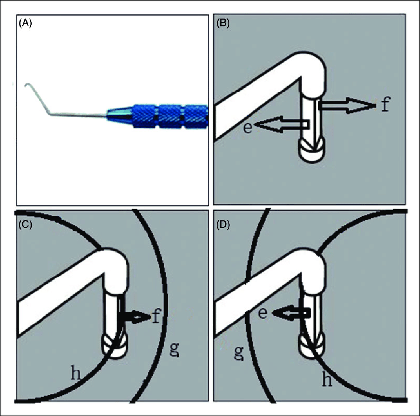 850x841 Schematic Drawing Of The Technique A L Shaped Chopper B Tip