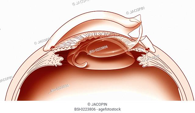 640x370 drawing visual cataract stock photos and images age fotostock