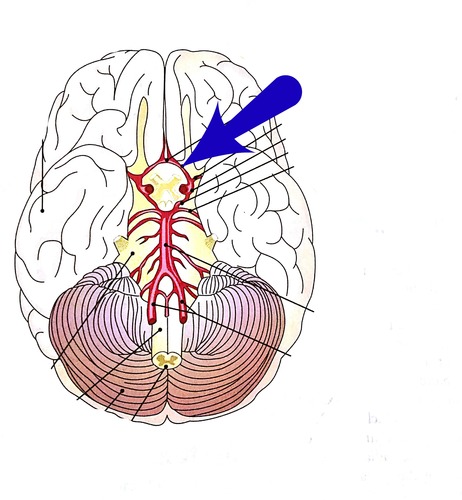 462x500 Cerebral Arterial Circle