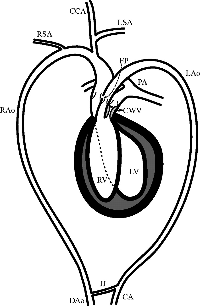 836x1280 delayed depolarization of the cog wheel valve and pulmonary