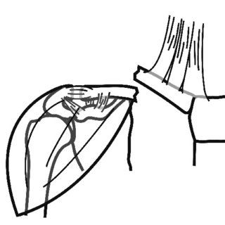 320x320 diagrammatic illustratiuon of deforming forces in a mid shaft