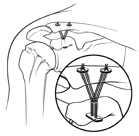 467x457 line drawing of double clavicular tunnel