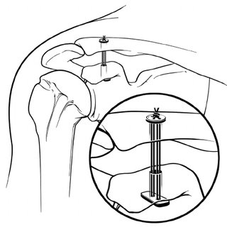 320x320 line drawing of native shoulder joints with intact