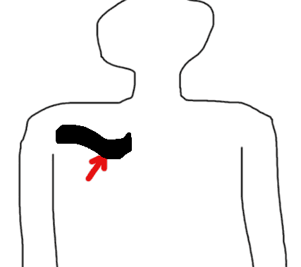 427x379 return of the king can ultrasound revive the subclavian line