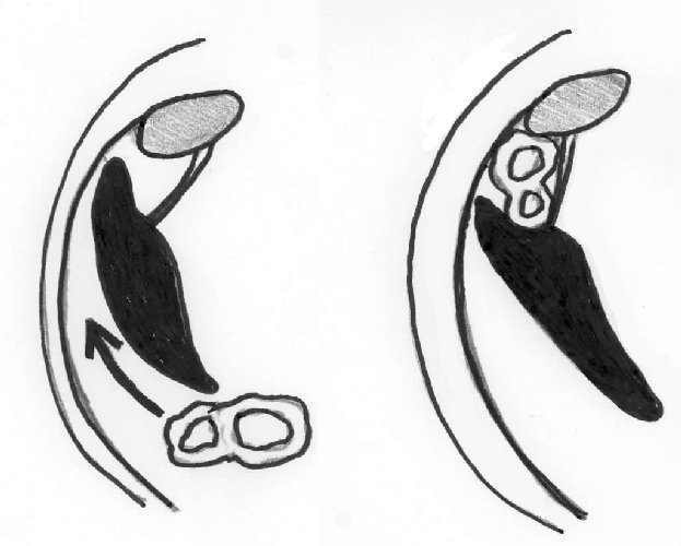 623x500 colon displacement