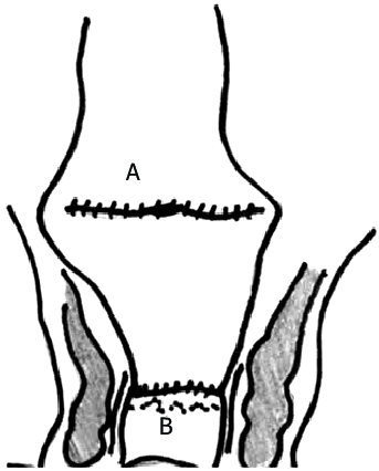 343x426 coloplasty anastomosis with coloplasty in colon