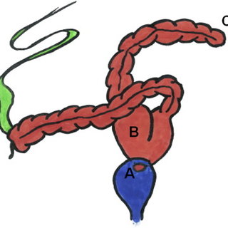 320x320 diagram of the malformation blue bladder red colon green