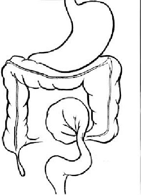 456x629 line diagram showing twisting of sigmoid colon around its