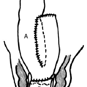 302x302 straight coloanal anastomosis with colon