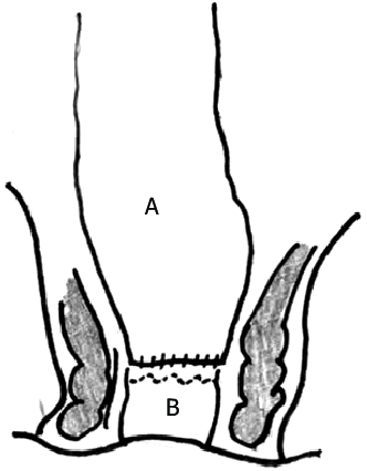 332x426 straight coloanal anastomosis with colon