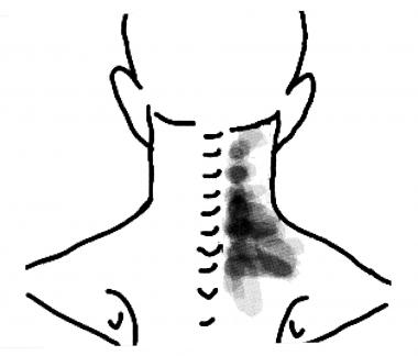 380x324 cervical facet syndrome clinical presentation history, physical