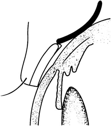 390x445 An Unusual Eyelid Lump Unsuspected Embedded Contact Lens For Up