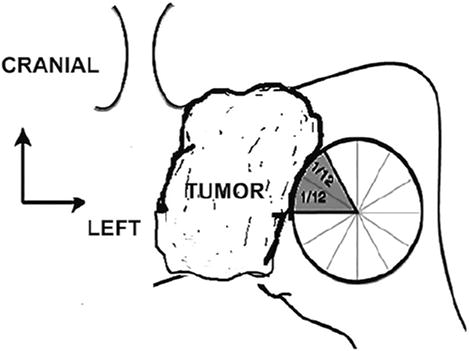 469x351 Endoscopic Endonasal Surgery For Nonadenomatous, Nonmeningeal