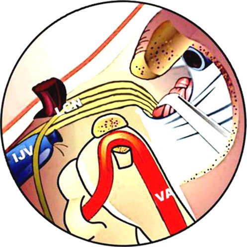 497x496 Schematic Drawing Showing A Left Juxtacondylar Approach